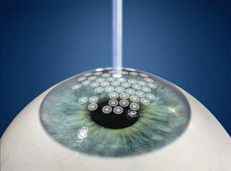Eye Being Hit With a Laser