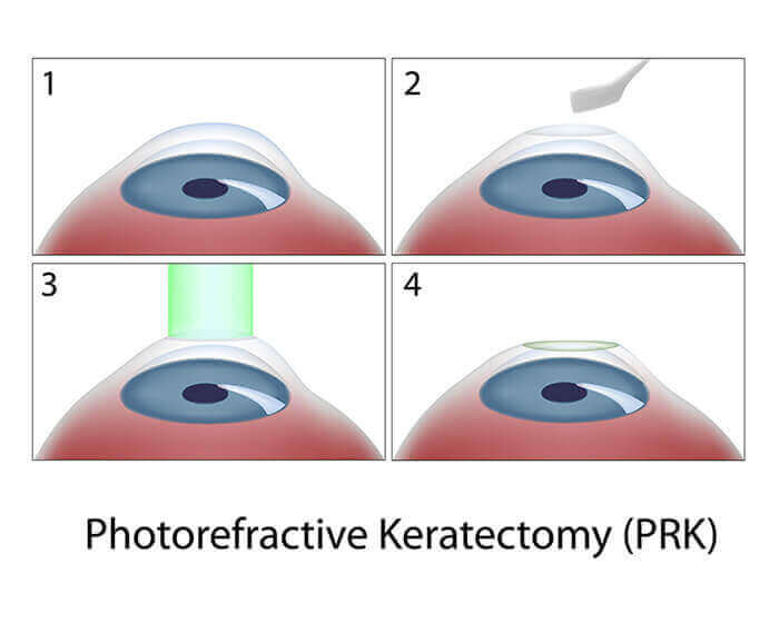 Chart Showing the Steps of PRK Surgery